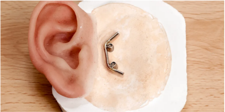 Custom auricular prosthesis (ear prosthetic) with implant attachment hardware