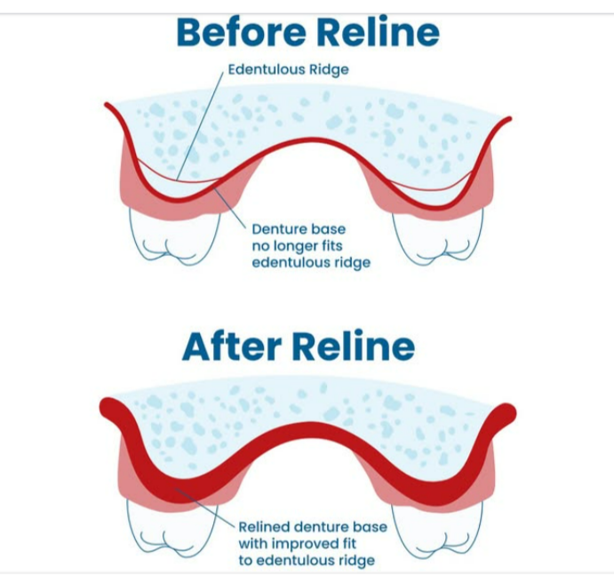 Before and after diagram showing how a denture reline restores fit to the edentulous ridge