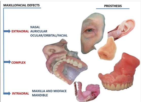 Diagram showing maxillofacial defects (extraoral, complex, intraoral) and corresponding prosthetic solutions