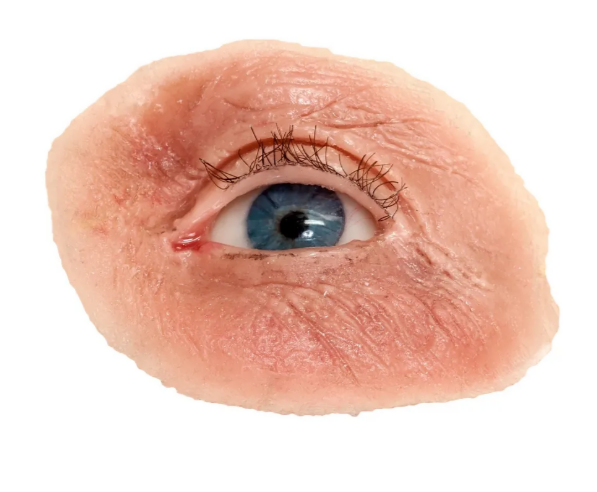 Custom orbital prosthesis showing realistic eye and surrounding tissue restoration