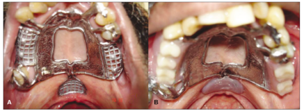 Clinical photograph of a palatal lift prosthesis device before and after fitting